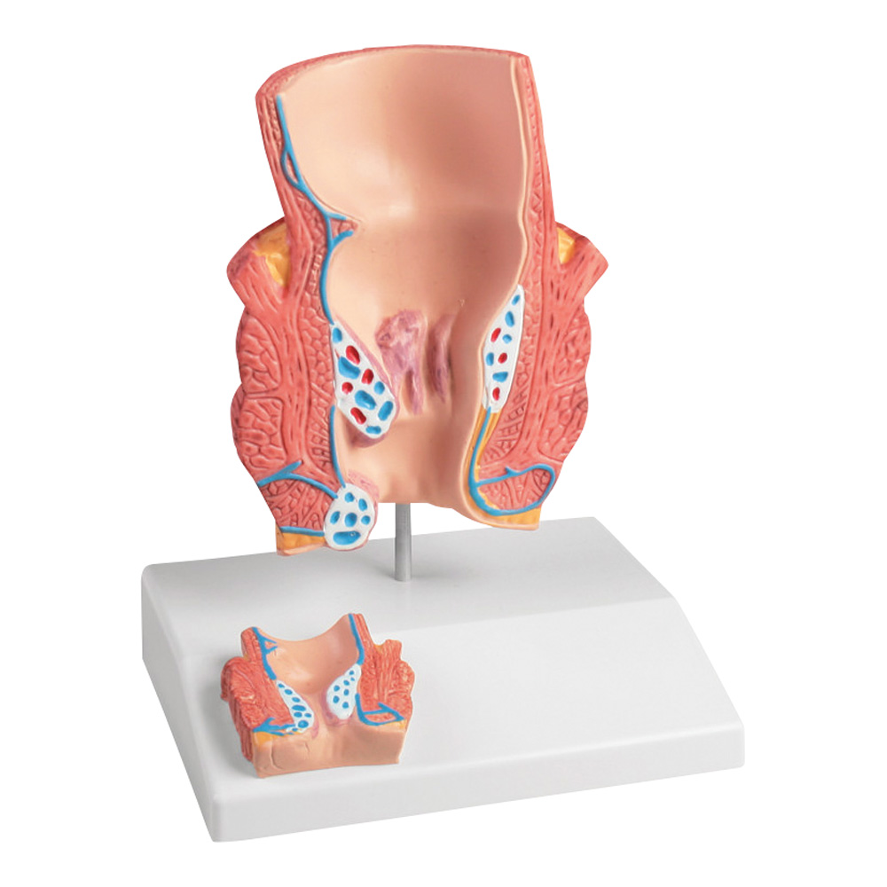 痔核モデル