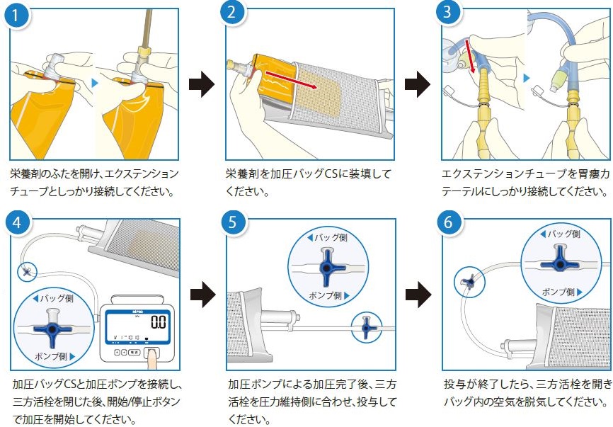 テルモ TERUMO 電動加圧ポンプ&加圧バック 胃ろう用 - 看護/介護用品